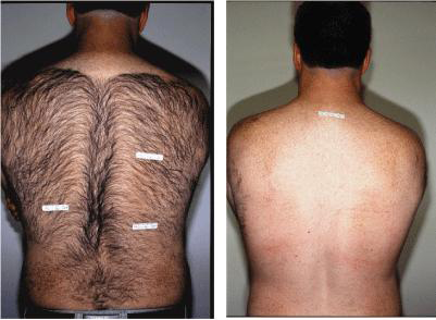 Larg7_9_2010laser-back-hair-removal