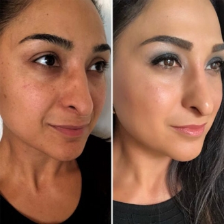 Skin-Resurfacing-and-Rejuvenation-thumbs-328X328